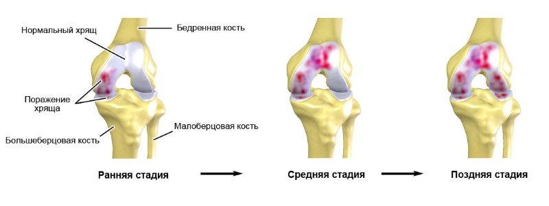 Показания к применению препарата: артроз и остеоартроз