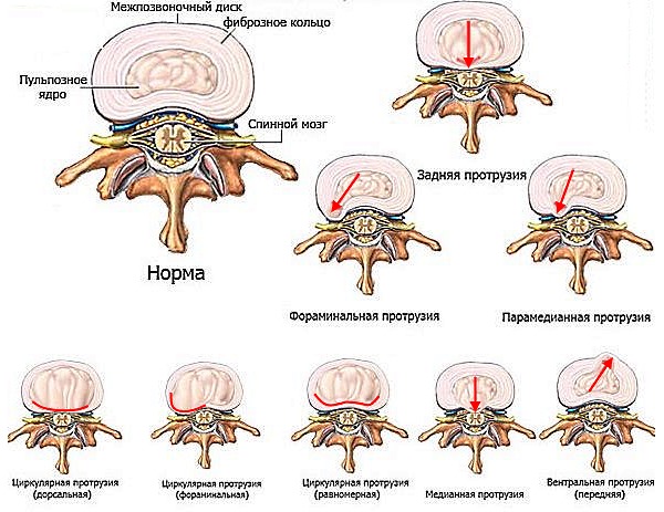Обратите внимание как выглядит классификация грыж позвоночника по направлению выпадения