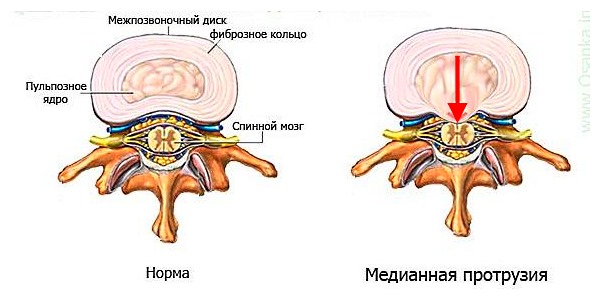 Медиальная грыжа опасна тем, что появляется риск повреждения спинного мозга