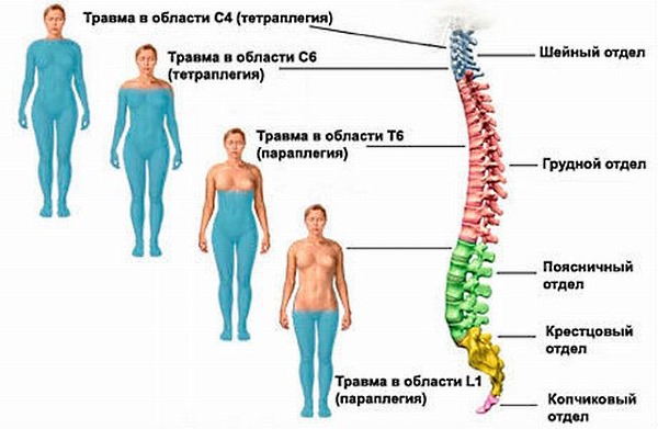 Клиническая картина зависит от места повреждения позвоночника