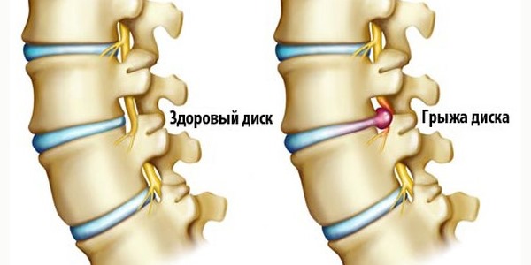Кифоз способствует развитию межпозвоночной грыжи