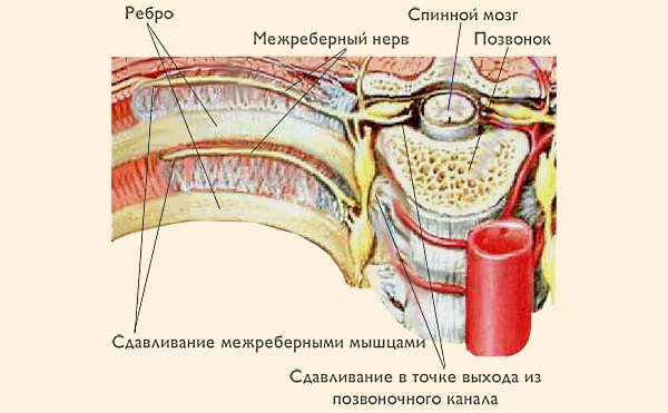 Межреберная невралгия развивается из-за зажатия нервных корешков отходящих от позвоночника вдоль ребер