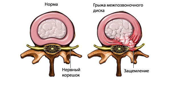 При остеохондрозе тракция позвоночника может привести к разрыву фиброзного кольца диска и появлению грыжи позвоночника