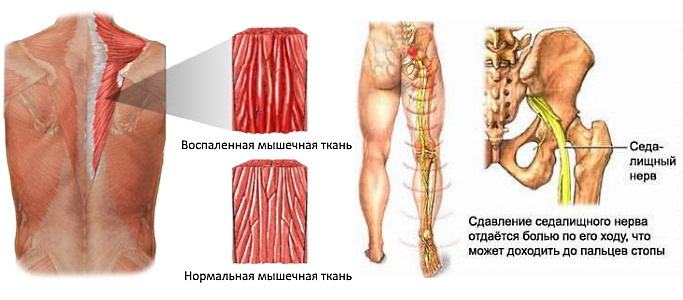 Мазь Аналгос назначают при различных мышечных болях и невралгиях
