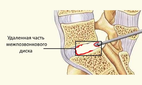 Часто при запущенных стадиях грыжи применяют оперативное вмешательство