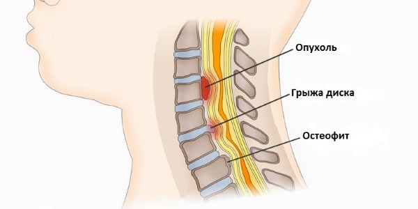 Вертеброгенная миелопатия развивается из-за наличия дегенеративных заболеваний позвоночника
