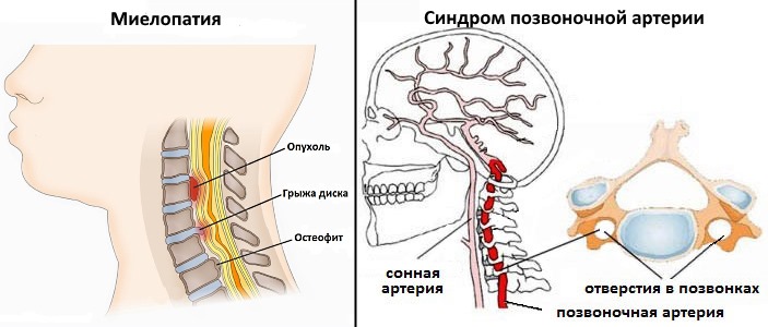 Наиболее опасное последствие дорсопатии шеи - это миелопатия и синдром позвоночной артерии
