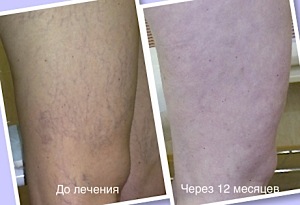 микросклеротерапии ног