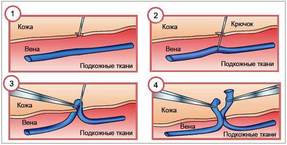 минифлебектомия