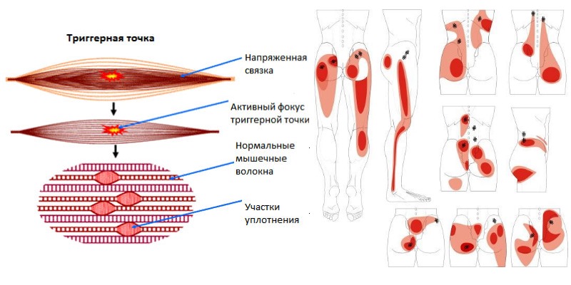 Дексалгин могут использовать люди страдающие от миофасциального синдрома
