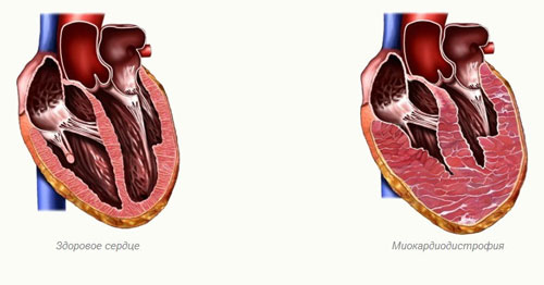 миокардиодистрофия