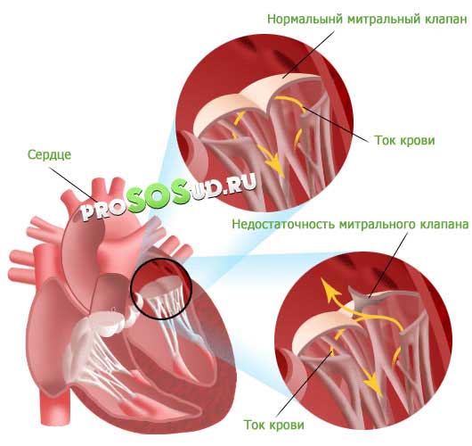 Недостаточность митрального клапана