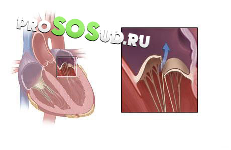 митральный клапан