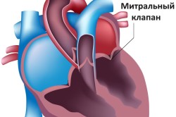 митральный клапан