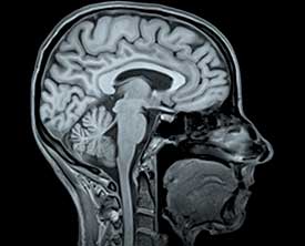 МРТ головного мозга
