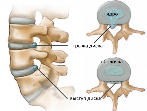 Вытекшее ядро межпозвонкового диска является грыжей позвоночника