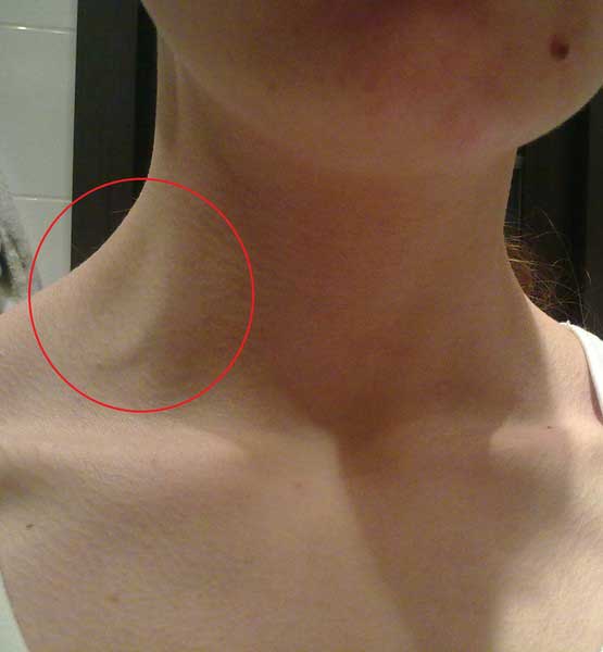 набухшая шейная вена