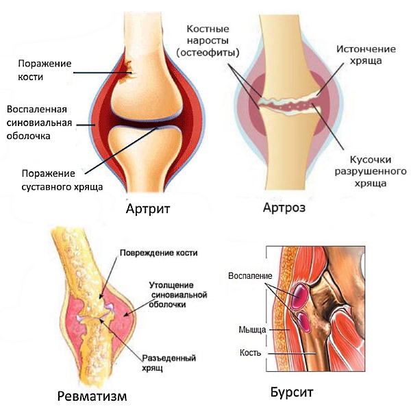 Крем Artraid позволяет справиться со всеми известными и самыми распространенными заболеваниями суставов