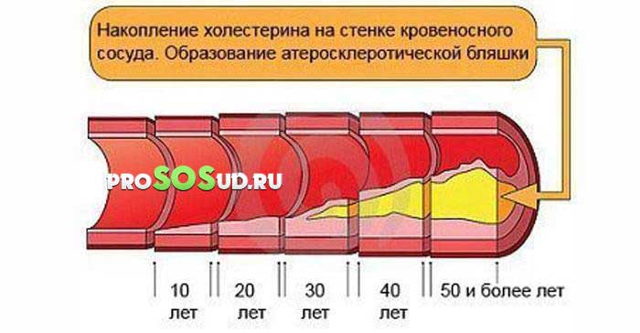 накопление холестерина в сосудах