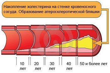 накопление холестерина
