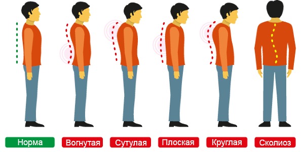 Нарушение осанки из-за больших нагрузок и заболеваний провоцируют болевой синдром в позвоночнике
