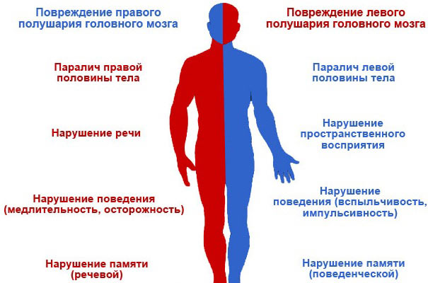нарушения вызываемые инсультом головного мозга