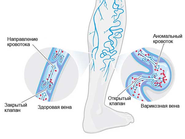 нарушение кровотока ног