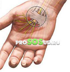 немеют руки