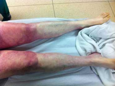 Закупорка сосудов на ногах