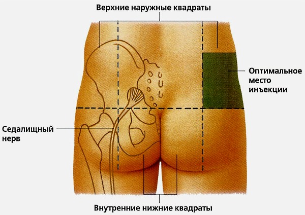 Если укол делается в ягодицу, то его делают в оптимальную зону, чтобы не задеть седалищный нерв