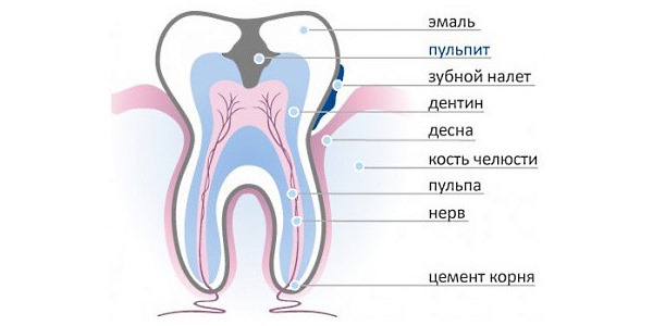 Назначают Ибупрофен Акрихин для купирования боли при воспалении зубного нерва