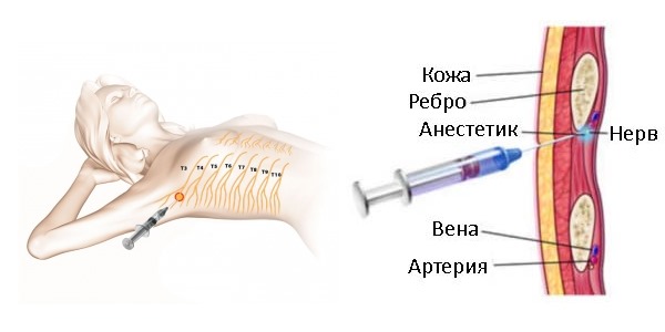 Когда устранить боль в межреберье не удается применяется новокаиновая блокада