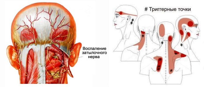 Часто Кеторолак включают в терапию миалгии и невралгии