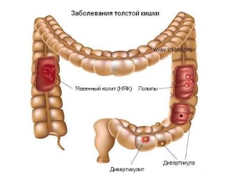 Так как в составе препарата присутствует диклофенак, его противопоказано принимать при нарушениях в ЖКТ