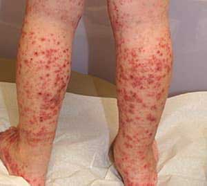 ноги в красных пятнах