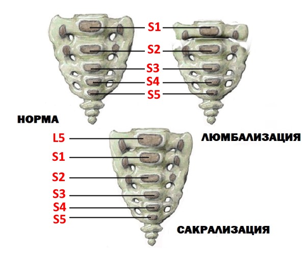 Сакрализация - сращение последнего поясничного позвонка с первым крестцовым