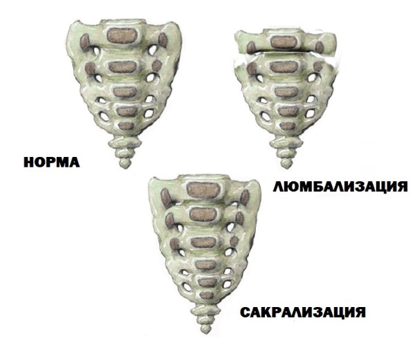 Обратите внимание, что представляет из себя сакрализация и люмбализация
