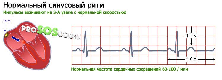Нормальный ритм сердца