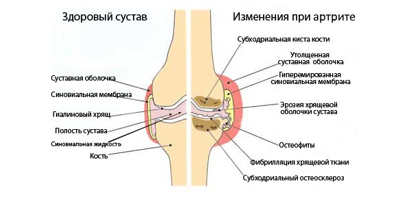 Целестон в таблетках назначают при ревматических поражениях