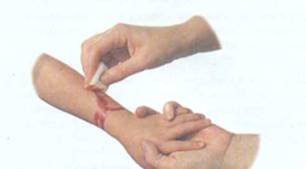 Обработка ран