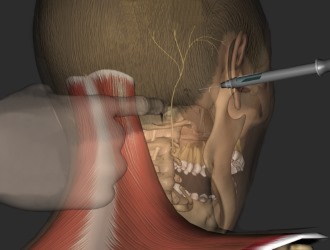 Блокада нерва - самый быстрый и действенный метод снять боль