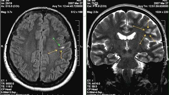 Очаговые изменения