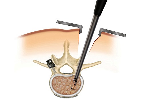 Эндоскопия выполняется через прокол в мягких тканях спины