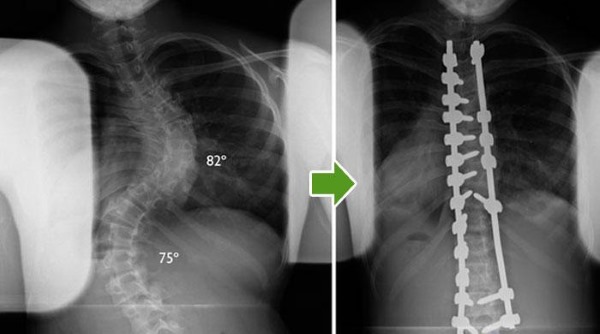 Рентгеновский снимок до и после операции на сколиозе