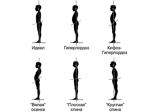 Корсеты назначают при различных типах искривления позвоночника