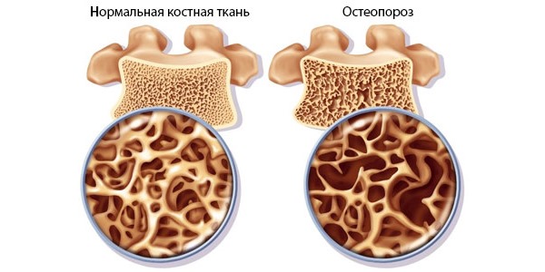 Основное показание к применению Остеокеа - профилактика дефицита кальция в организме