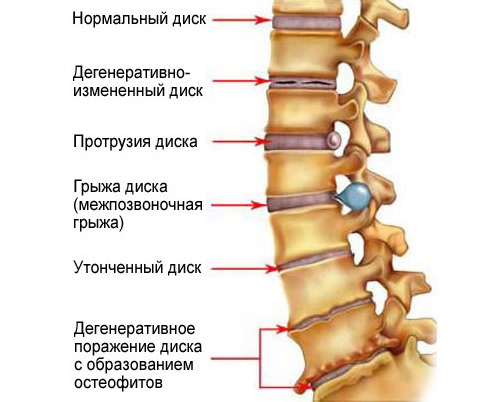 Эльбона помогает устранить разрушение хрящевой ткани в позвонках и других суставах