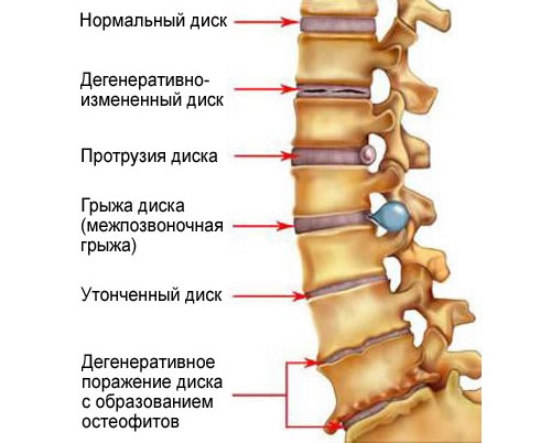 Никофлекс назначают при остеохондрозе различных отделов позвоночника