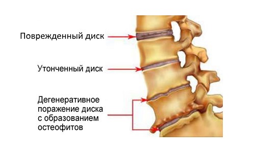 Дегенеративные изменения в позвоночнике сопровождаются постоянными болями в спине