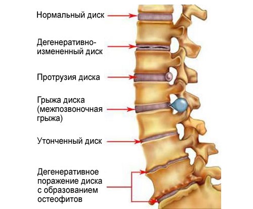 Очень часто масло пихты используют для лечения заболеваний спины, в частности остеохондроза